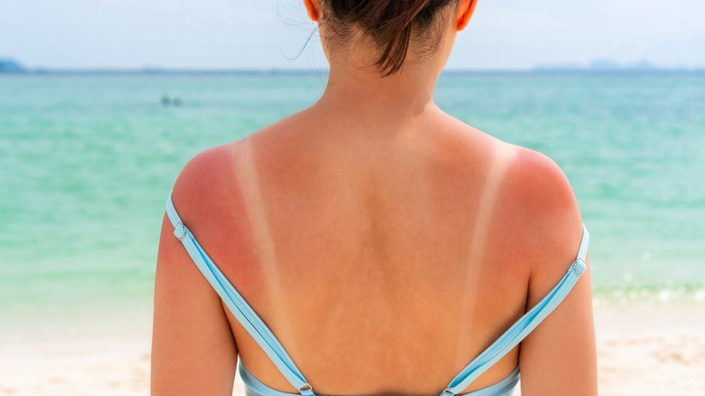 Sunburned woman's back