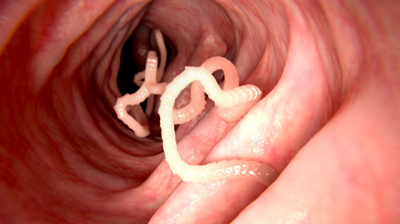 Tapeworm in a colon