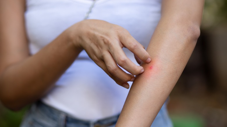 woman scratching mosquito bite