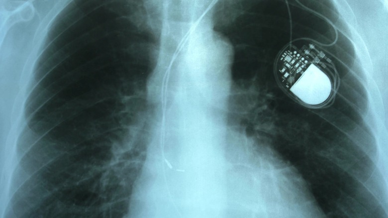 X-ray of patient with pacemaker