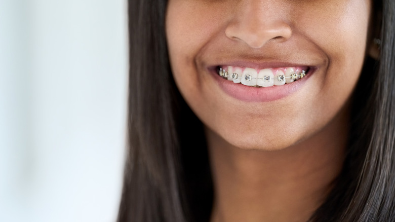 Person smiling with braces