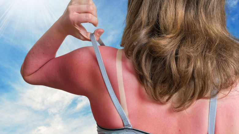 woman with sunburned skin